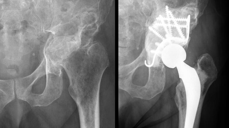 Radiographie d'une hanche