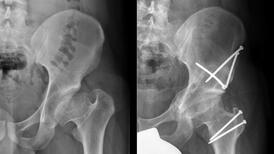 Radiographie d'une hanche