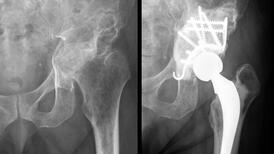 Radiographie d'une hanche
