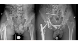 Ostéosynthèse polytraumatisé
